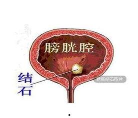 肾结石吃土瓜,天然疗法与生活调养相结合