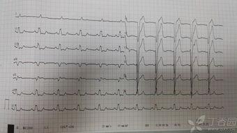 齐鲁医院心电图吃瓜,吃瓜群众的心脏健康指南